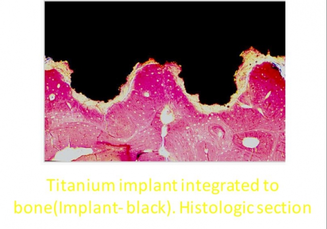 Immediate vs. Delayed Implant Loading JeffreyBonk immediate vs delayed implant loading Fig.8