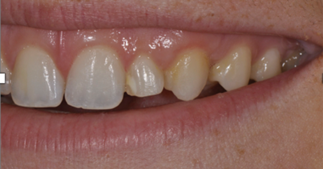 Simple Implant Surgical Guides and Implant Mapping JeffreyBonk simple implant surgical guides and implant mapping Fig.1