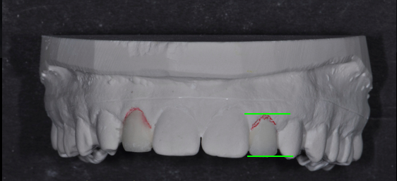 Simple Implant Surgical Guides and Implant Mapping JeffreyBonk simple implant surgical guides and implant mapping Fig.2