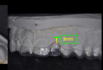 Simple Implant Surgical Guides and Implant Mapping JeffreyBonk simple implant surgical guides and implant mapping Fig.3