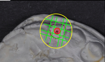 Simple Implant Surgical Guides and Implant Mapping JeffreyBonk simple implant surgical guides and implant mapping Fig.4