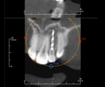Simple Implant Surgical Guides and Implant Mapping JeffreyBonk simple implant surgical guides and implant mapping Fig.5