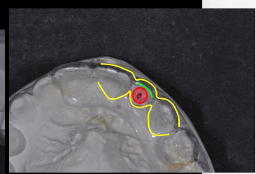 Simple Implant Surgical Guides and Implant Mapping JeffreyBonk simple implant surgical guides and implant mapping Fig.6