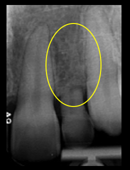 Simple Implant Surgical Guides and Implant Mapping JeffreyBonk simple implant surgical guides and implant mapping Fig.7