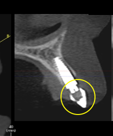 Simple Implant Surgical Guides and Implant Mapping JeffreyBonk simple implant surgical guides and implant mapping Fig.8