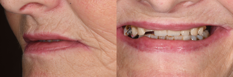 A-EFSB: Airway and 3D Treatment Planning JeffreyRouse airway and 3d treatment planning FIg.1