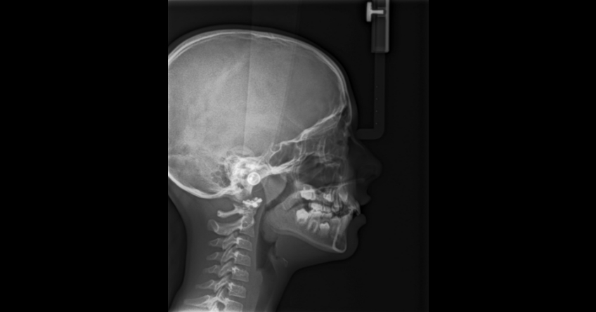 JeffreyRouse dentistry and three common compromised craniofacial anatomy Fig.2
