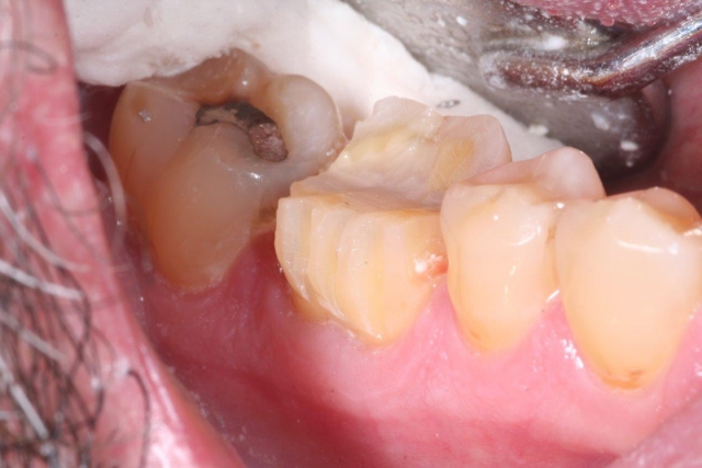 5 Considerations for Better and Faster Crown Preparations John Carson 5 Considerations for Better and Faster Crown Preparations Figure 1