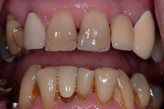 John Carson An Insidious Yet Often Missed Dental Wear Pattern Featured Image