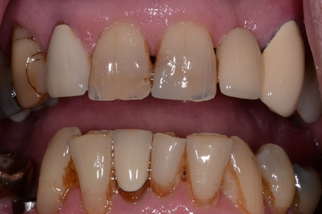 An Insidious Yet Often Missed Dental Wear Pattern John Carson An Insidious Yet Often Missed Dental Wear Pattern Figure 1