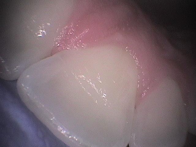 An Insidious Yet Often Missed Dental Wear Pattern John Carson An Insidious Yet Often Missed Dental Wear Pattern Figure 2