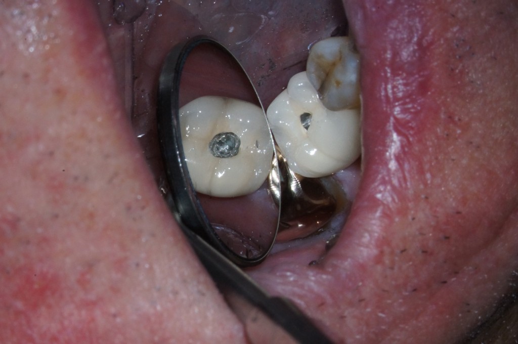 Dealing With a Loose Implant Crown John Carson Dealing With a Loose Implant Crown Figure 1