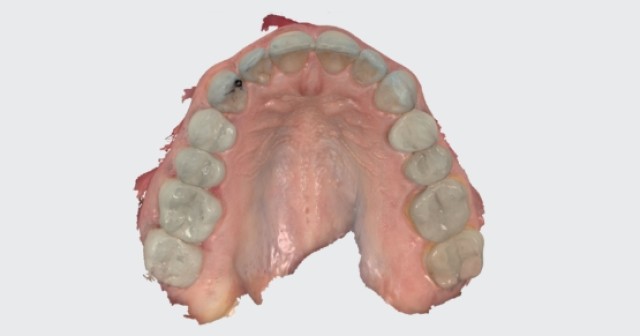 Intraoral Scanning Techniques: Minimizing Errors