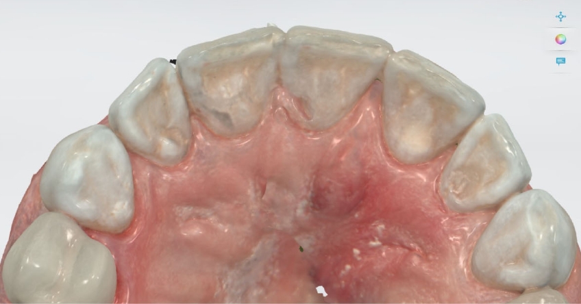 Intraoral Scanning Techniques: Minimizing Errors John Carson Intraoral Scanning Techniques Figure 4