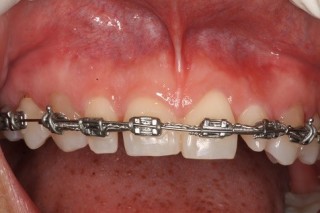 Why Gingivectomies Fail John Carson Why Gingivectomies Fail Featured Image