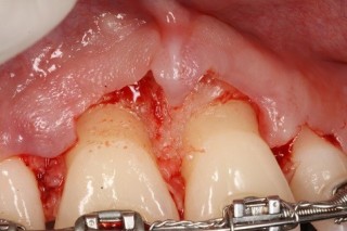 Why Gingivectomies Fail John Carson Why Gingivectomies Fail Figure 1
