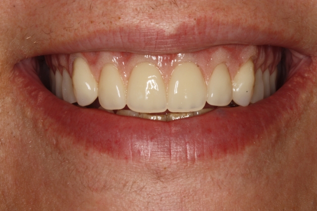 Best Practices for Denture Teeth Selection Kevin Huff Best Practices for Denture Teeth Selection Figure 2