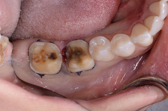 The Infamous Mandibular Block Kevin Kwiecien The Infamous Mandibular Block Featured Image