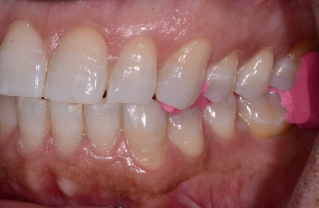 Bite Records For a MAD in the Digital World KevinKwiecien bite records for a mad in the digital world Fig.2