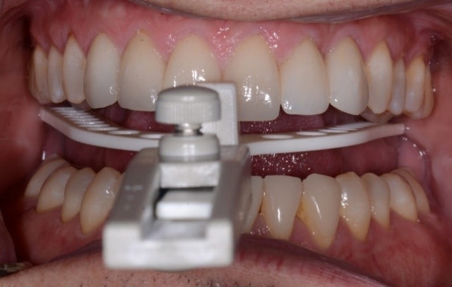 Bite Records For a MAD in the Digital World KevinKwiecien bite records for a mad in the digital world Fig.4