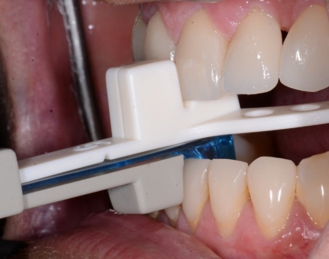 Bite Records For a MAD in the Digital World KevinKwiecien bite records for a mad in the digital world Fig.5