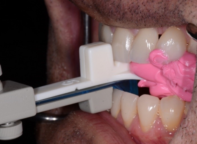 Bite Records For a MAD in the Digital World KevinKwiecien bite records for a mad in the digital world Fig.8