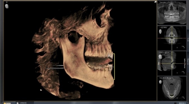 Bite Records For a MAD in the Digital World KevinKwiecien bite records for a mad in the digital world Fig.9