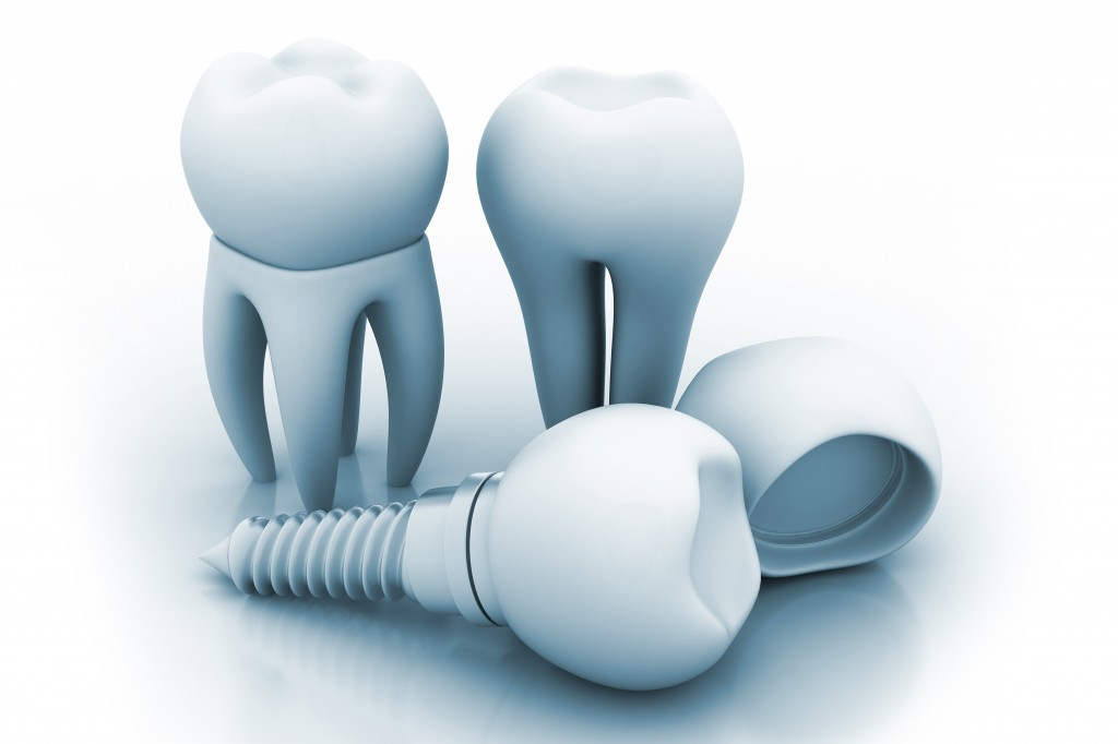 Should You Probe Dental Implants? Kinzer Probe Implants Featured Image
