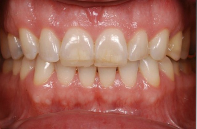 Why You Should Be Using Glycerin on Your Composite Restorations