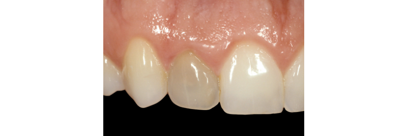 Internal Bleaching of the Dark Tooth Kinzer internal bleaching dark tooth 01 1