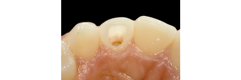 Internal Bleaching of the Dark Tooth Kinzer internal bleaching dark tooth 03