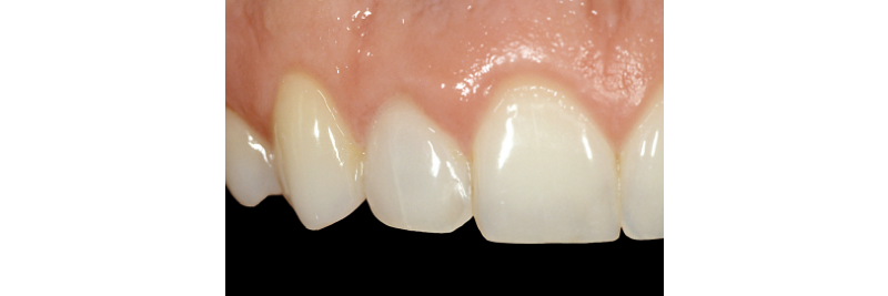 Internal Bleaching of the Dark Tooth Kinzer internal bleaching dark tooth 04