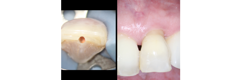 Internal Bleaching of the Dark Tooth Kinzer internal bleaching dark tooth 06