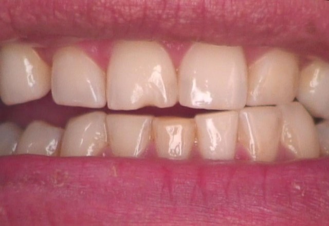 8 Steps for the Esthetic ‘Emergency’ Anterior Composite