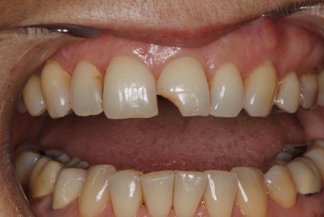 A Hot Tip for Handling Your Anterior Composite Emergency Patients Lavigne hot tip for handling anterior composite 01