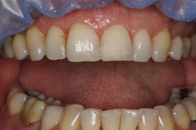 A Hot Tip for Handling Your Anterior Composite Emergency Patients Lavigne hot tip for handling anterior composite 02