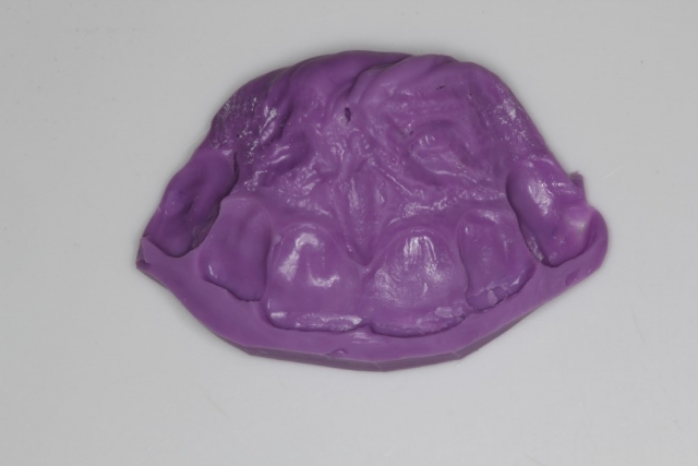 A Hot Tip for Handling Your Anterior Composite Emergency Patients Lavigne hot tip for handling anterior composite 03