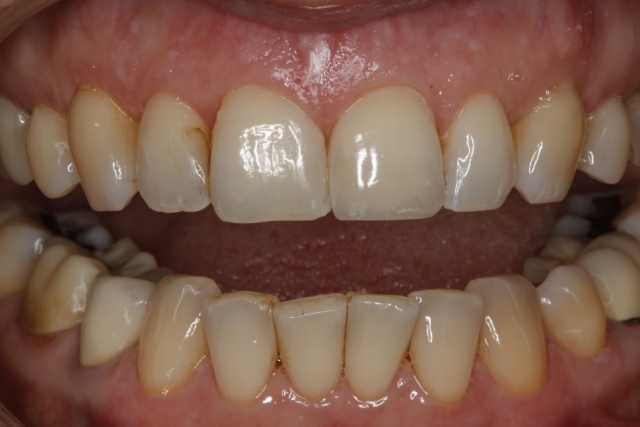 A Hot Tip for Handling Your Anterior Composite Emergency Patients Lavigne hot tip for handling anterior composite 04