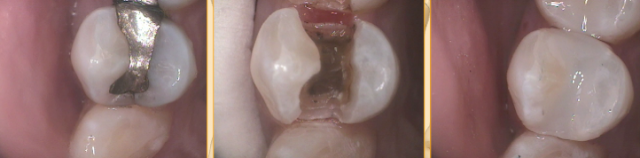 A Protocol for Symptom-Free Direct Composites Lavigne protocol sympton free direct 01