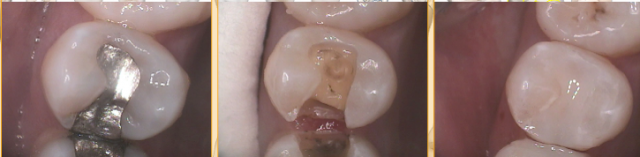 A Protocol for Symptom-Free Direct Composites Lavigne protocol sympton free direct 02