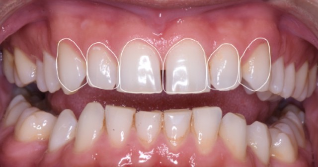 The Importance of Using Dental Templates
