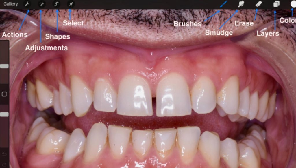 The Importance of Using Dental Templates Leila Zadeh Dental Templates Fig 1