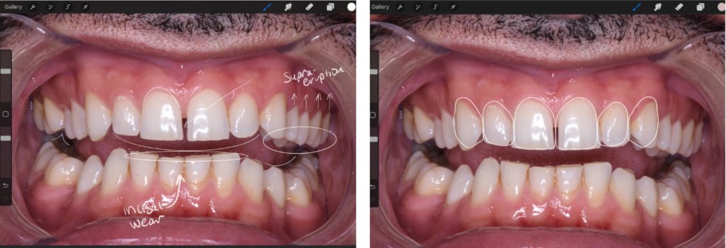 The Importance of Using Dental Templates Leila Zadeh Dental Templates Fig 2