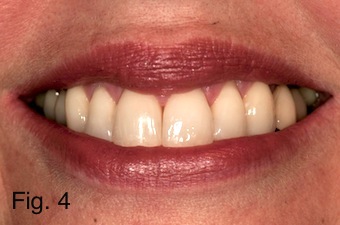 Positioning Maxillary Incisal Edges: Lip Mobility Lip Mobility figure 4 copy