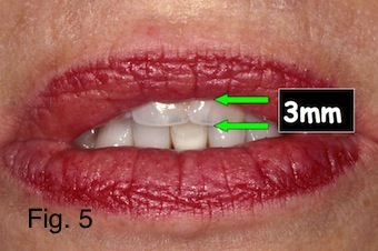 Positioning Maxillary Incisal Edges: Lip Mobility Lip Mobility.figure 5 copy