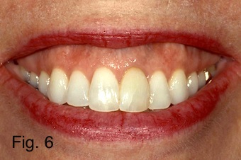 Positioning Maxillary Incisal Edges: Lip Mobility Lip Mobility.figure 6 copy