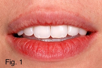 Positioning Maxillary Incisal Edges: Lip Mobility Lip mobility figure 1 copy
