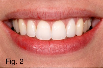 Positioning Maxillary Incisal Edges: Lip Mobility Lip mobility figure 2 copy