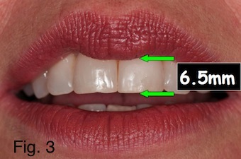 Positioning Maxillary Incisal Edges: Lip Mobility Lip mobility figure 3 copy