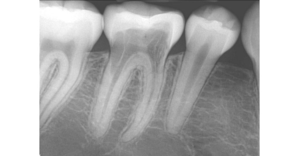 Invasive Cervical Root Resorption: The New Dental Epidemic? LouBerman InvasiveCervicalRootResp Fig.1